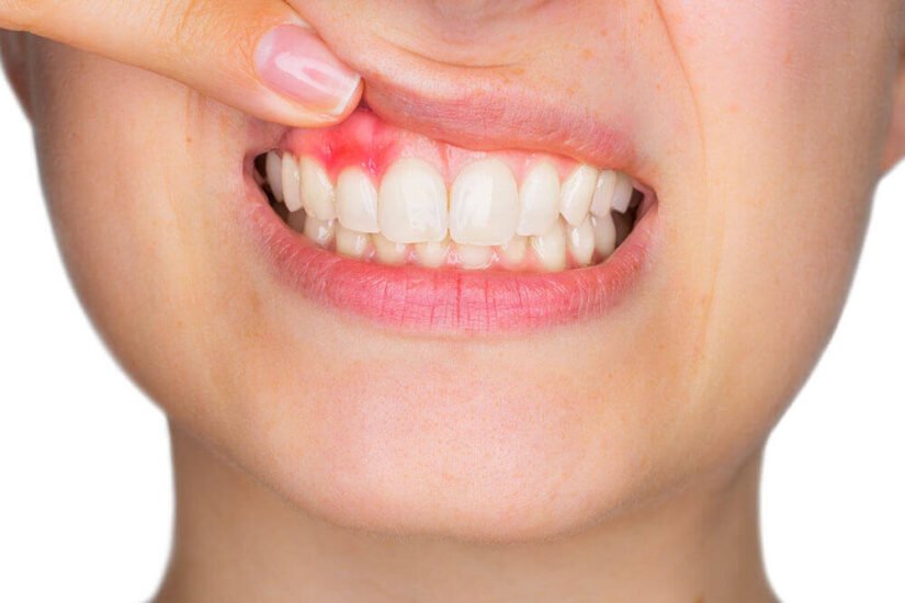 Behandlung von Zahnfleischerkrankungen Bodrum Zahnarzt