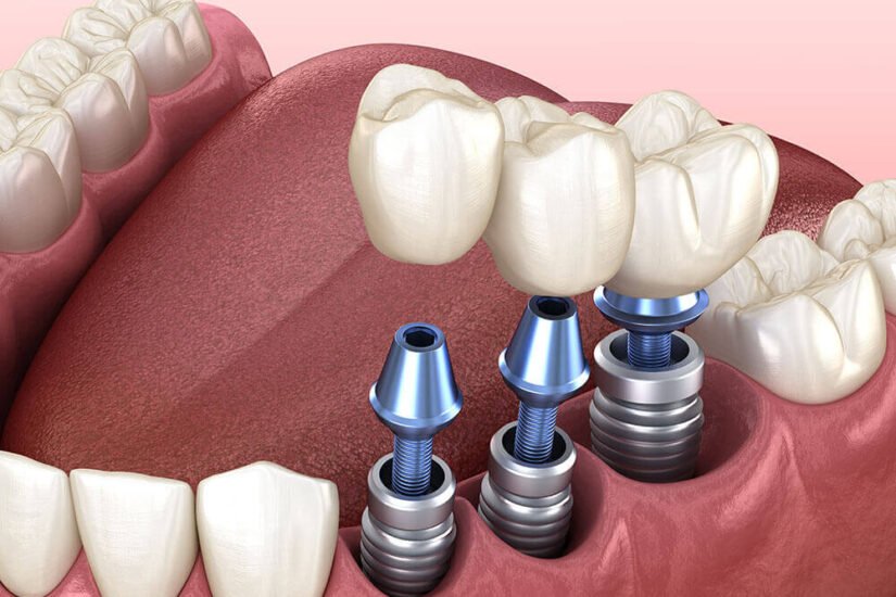 Fehlende Zahnvervollständigung mit Implantatbehandlung in Bodrum