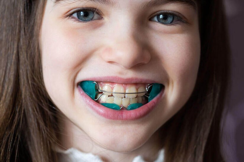 Pädiatrische Kiefer- und Gesichtsorthopädie Bodrum Zahnarzt