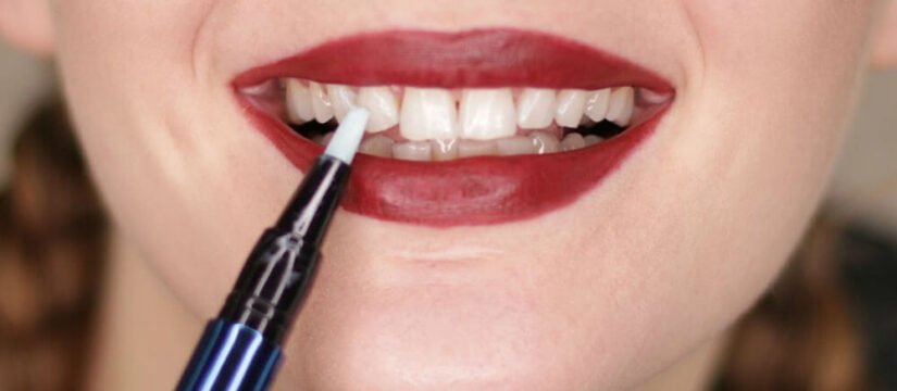 Что такое ручка для отбеливания зубов? Это работает?