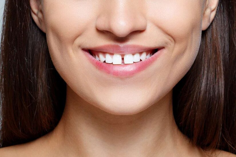 Лечение щелей между зубами при диэстеме